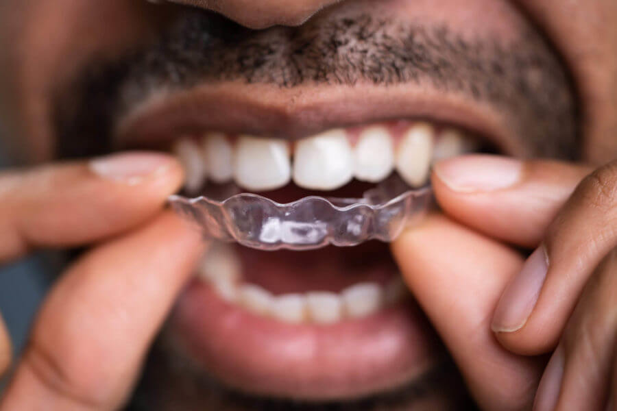 Clear Aligners in Kyle, TX