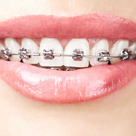 close-up picture of women with braces